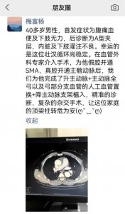 ​男子出汗后猛吹空调诱发主动脉夹层（诱发主动脉夹层的危险因素）