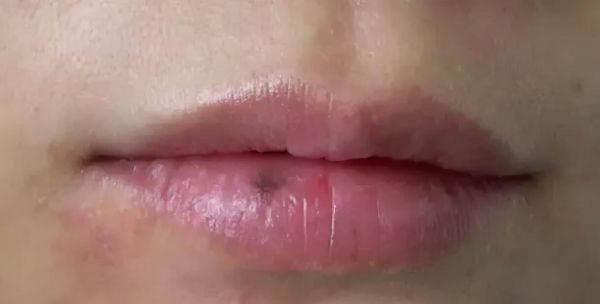 喝了红酒后嘴唇发黑