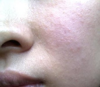 ​化妆品过敏症状的主要表现(化妆品过敏症状及治疗)