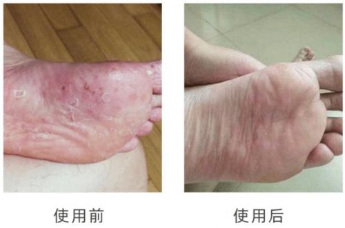 脚气脚臭怎么治疗能除根(脚气脚臭怎么治疗方法)-第1张图片-