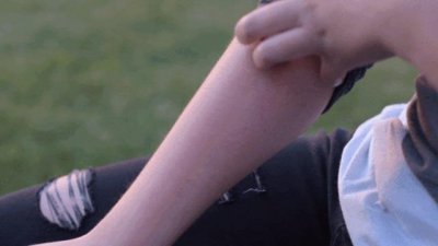 ​女子称熬夜致免疫力低下确诊紫癜 熬夜会带来哪些危害