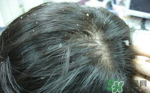 头皮屑多又痒怎么办?头皮屑又多又痒怎么去除?