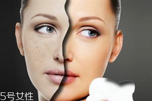太阳穴长痘痘是什么原因 怎么避免长痘痘 