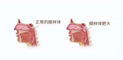 ​几张图来认识下腺样体面容 有孩子的家长多看看