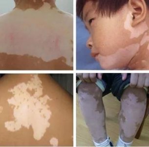 ​到底多大面积的白斑才被称为大面积白斑