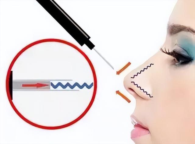 目前哪种隆鼻比较好（市面上的隆鼻技术你都有所了解吗）(3)