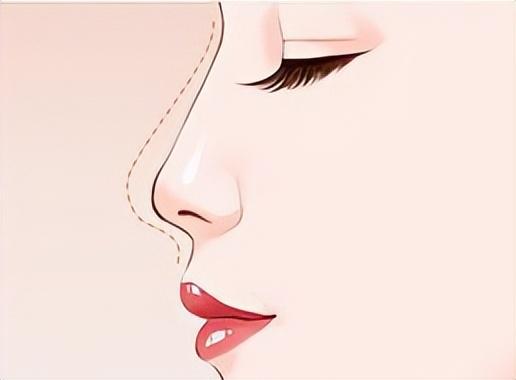 目前哪种隆鼻比较好（市面上的隆鼻技术你都有所了解吗）(5)