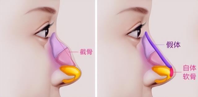 目前哪种隆鼻比较好（市面上的隆鼻技术你都有所了解吗）(4)