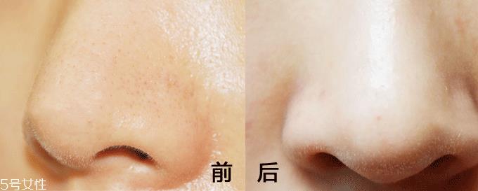 面膜什么成分能清洁毛孔 高岭土能深层清洁